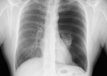 Pneumothorax X-Ray