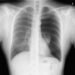 Pneumothorax X-Ray