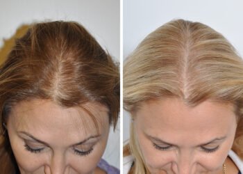 Follicular Unit Transplantation for Women – What You Need to Know