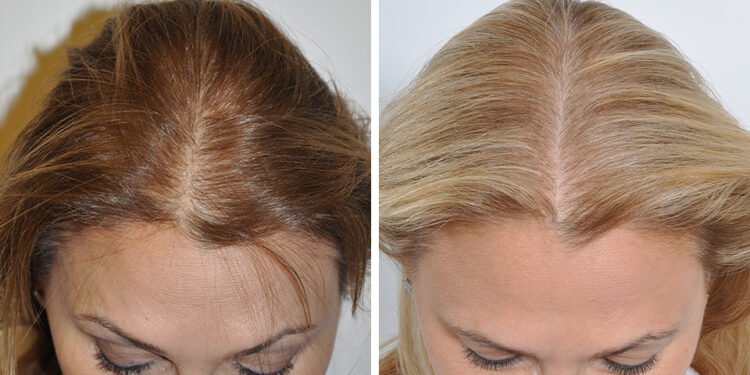 Follicular Unit Transplantation for Women – What You Need to Know