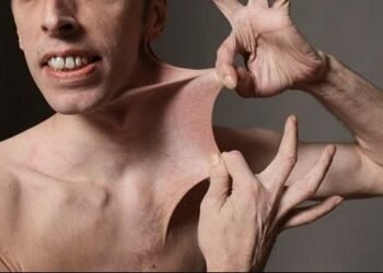 Navigating the Medical System With Ehlers-Danlos Syndrome