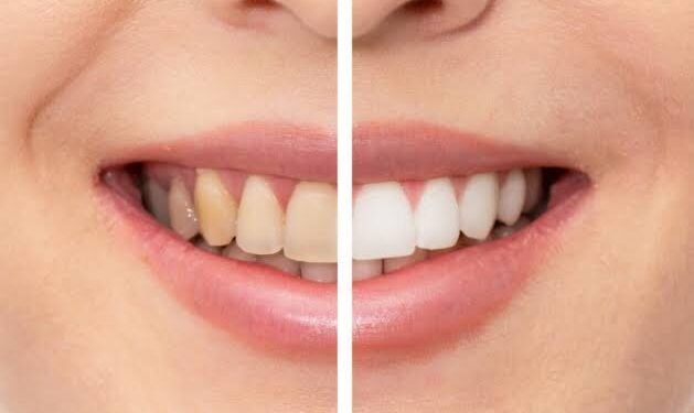 The Importance of Quality Teeth Whitening Products for Your Beauty Business