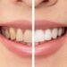 The Importance of Quality Teeth Whitening Products for Your Beauty Business